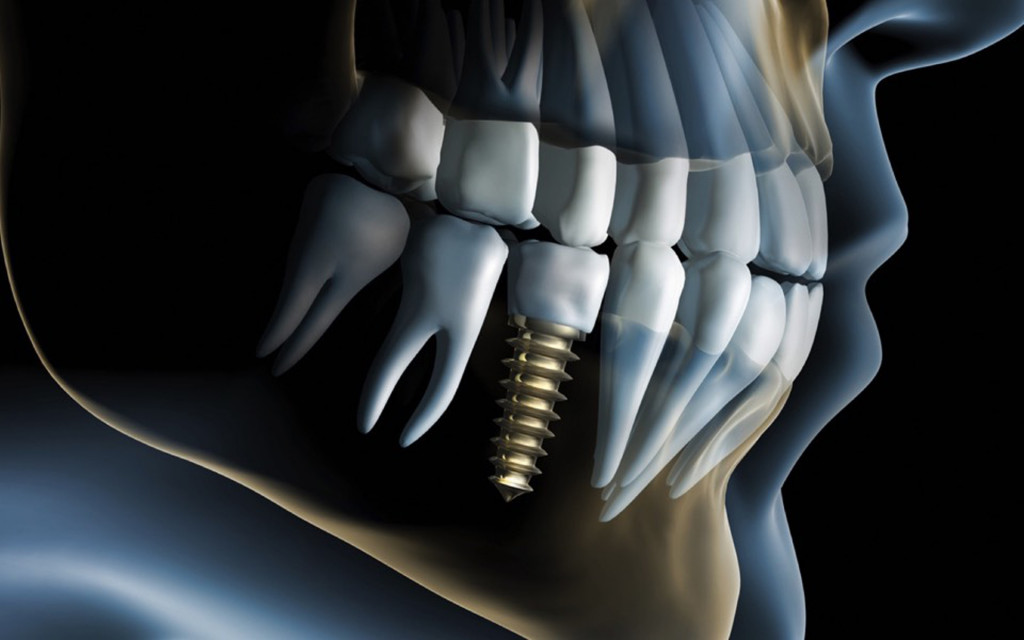 Le biotecnologie nell’implantologia