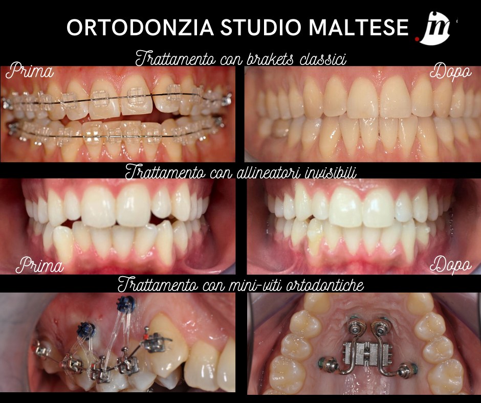Ortodonzia con allineatori e brakets classici