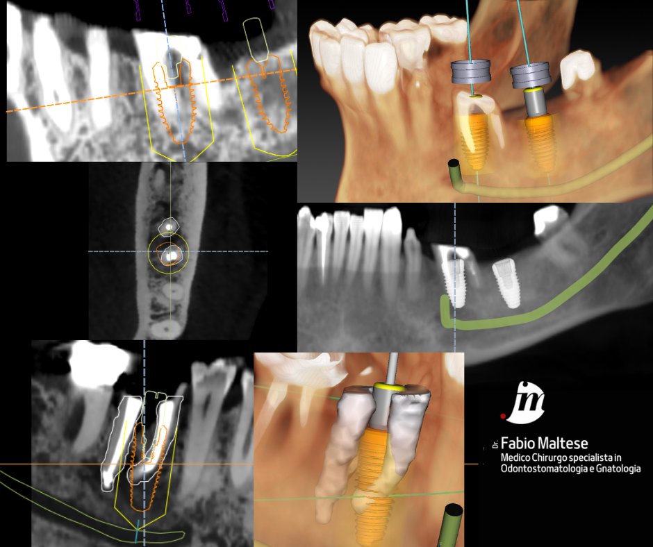 Implantologia Computer Guidata | Computer Guided Implantology