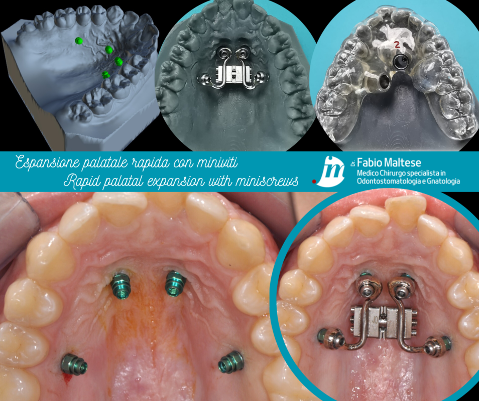 Ortodonzia con Mini-Viti (TADS)