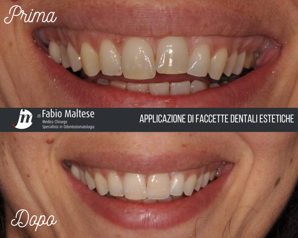 FACCETTE DENTALI ESTETICHE