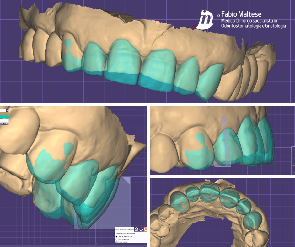 Faccette Dentali Dental Veneers